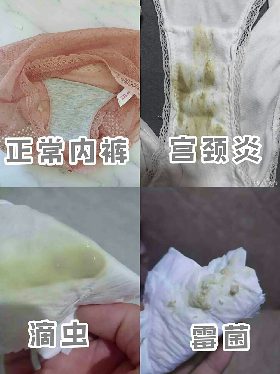 你属于哪种白带?注意私处健康!
