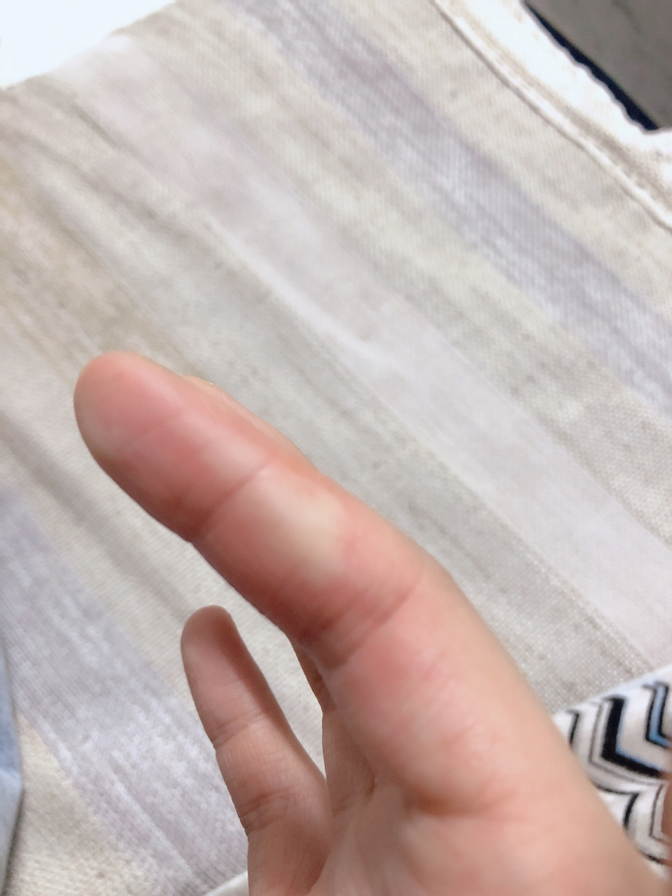 手指被烫起泡 今天在我妈那吃饭,被亲妈坑了.我妈在炸虾仁.