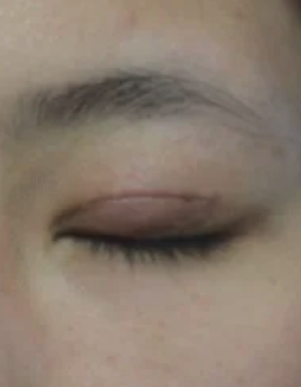 做完双眼皮手术眼角有增生怎么办?
