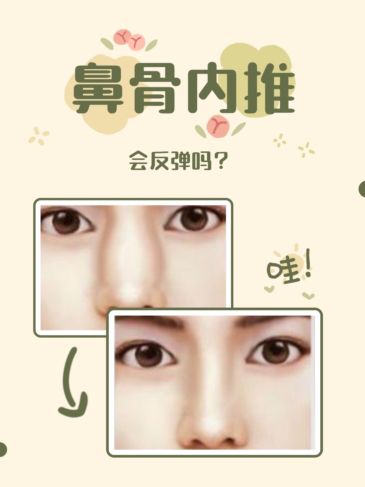 "很多朋友就质疑,这鼻骨内推是不是不值得做,后遗症太大…… 先别慌.