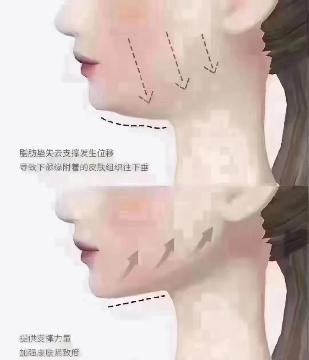 不是瘦就一定有,要紧致 少女线也叫轮廓线,美人线 主要表现面部下颚