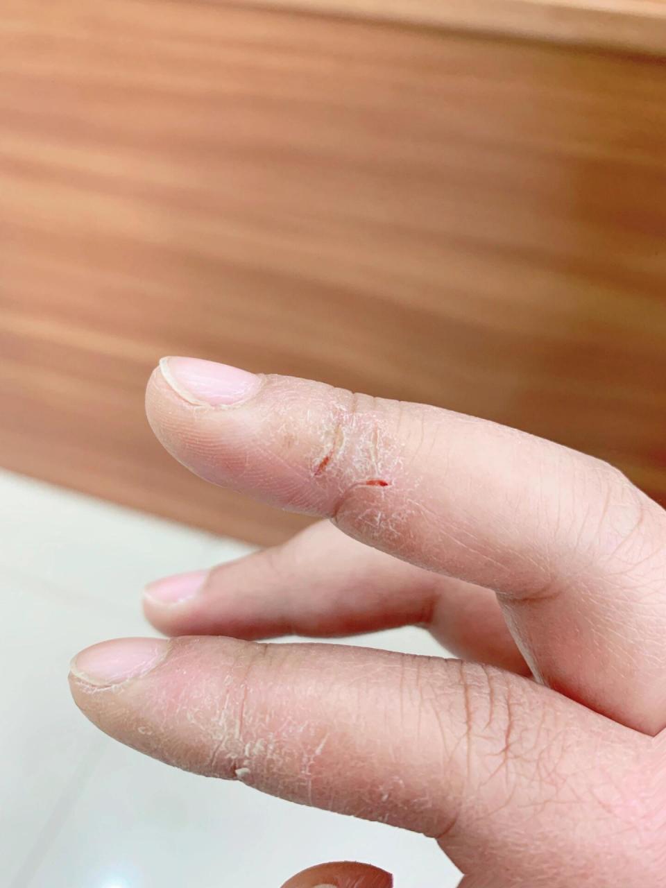 手指开裂变严重了!