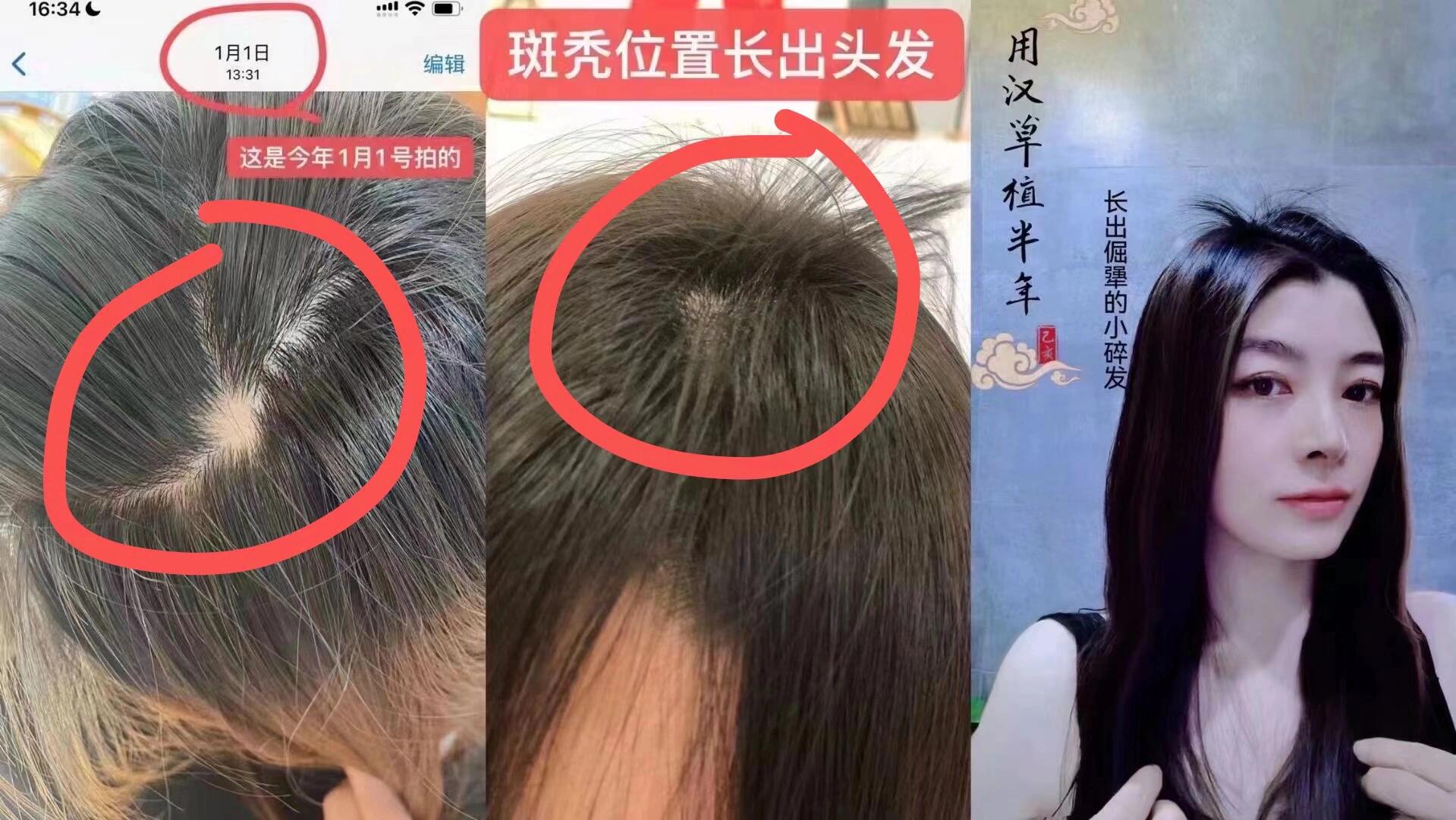 为什么头发会突然秃了一块可以长出来头发么为什么在线 为什么头发会突然秃了一块可以长出来头发么为什么在线