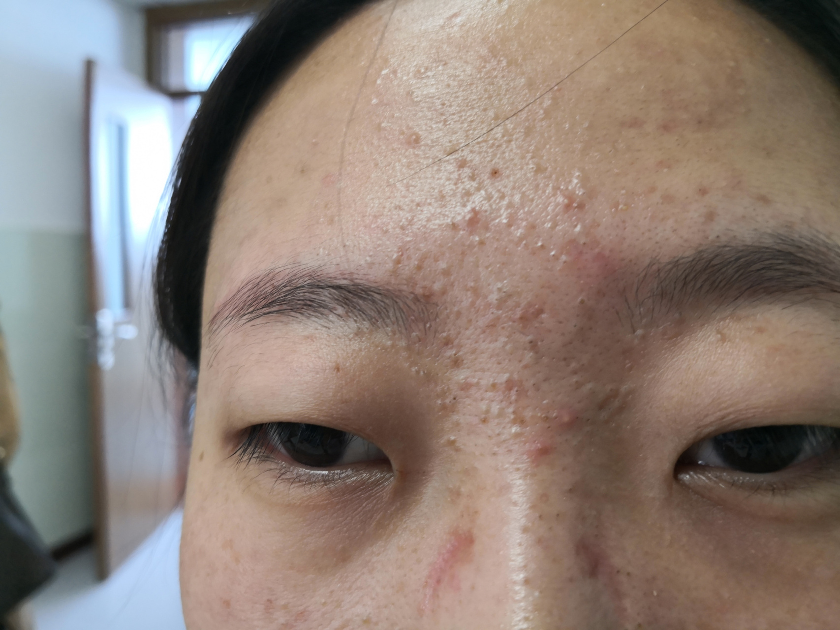 面部痤疮常见症状.额头面颊口周炎症性丘疹红斑脓疱明显.