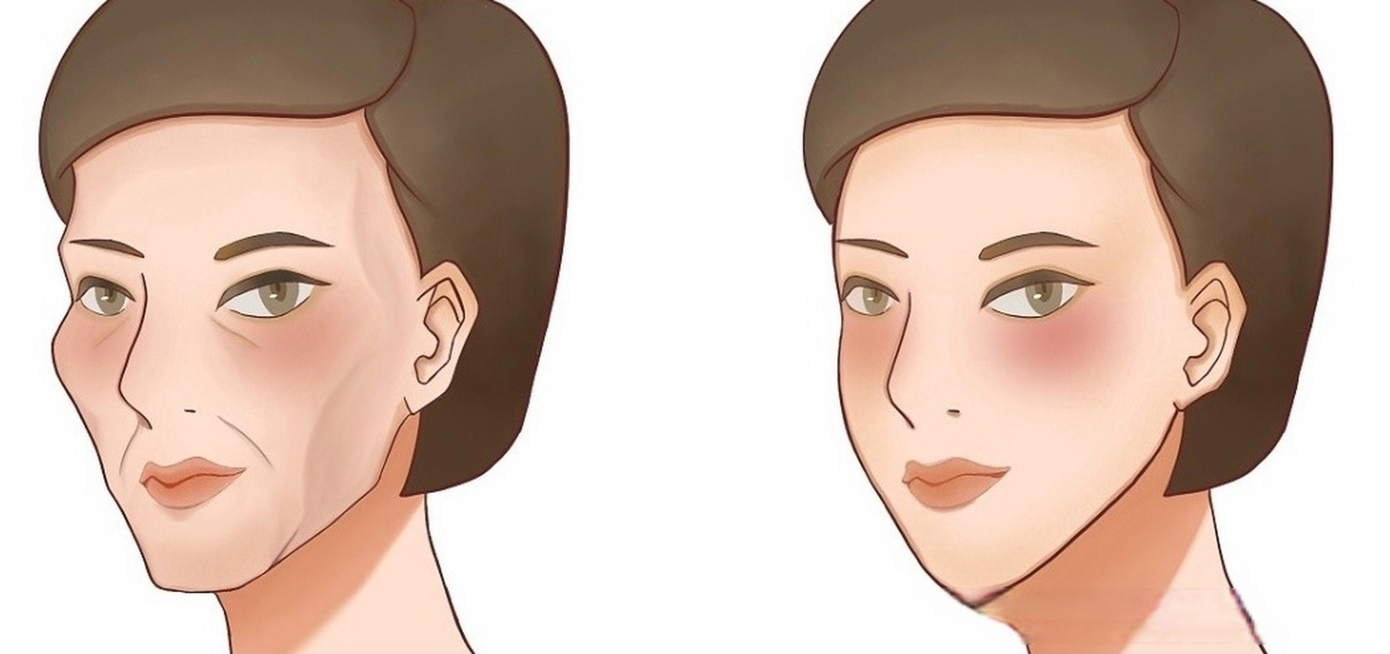 脸颊凹陷为什么填完不自然?