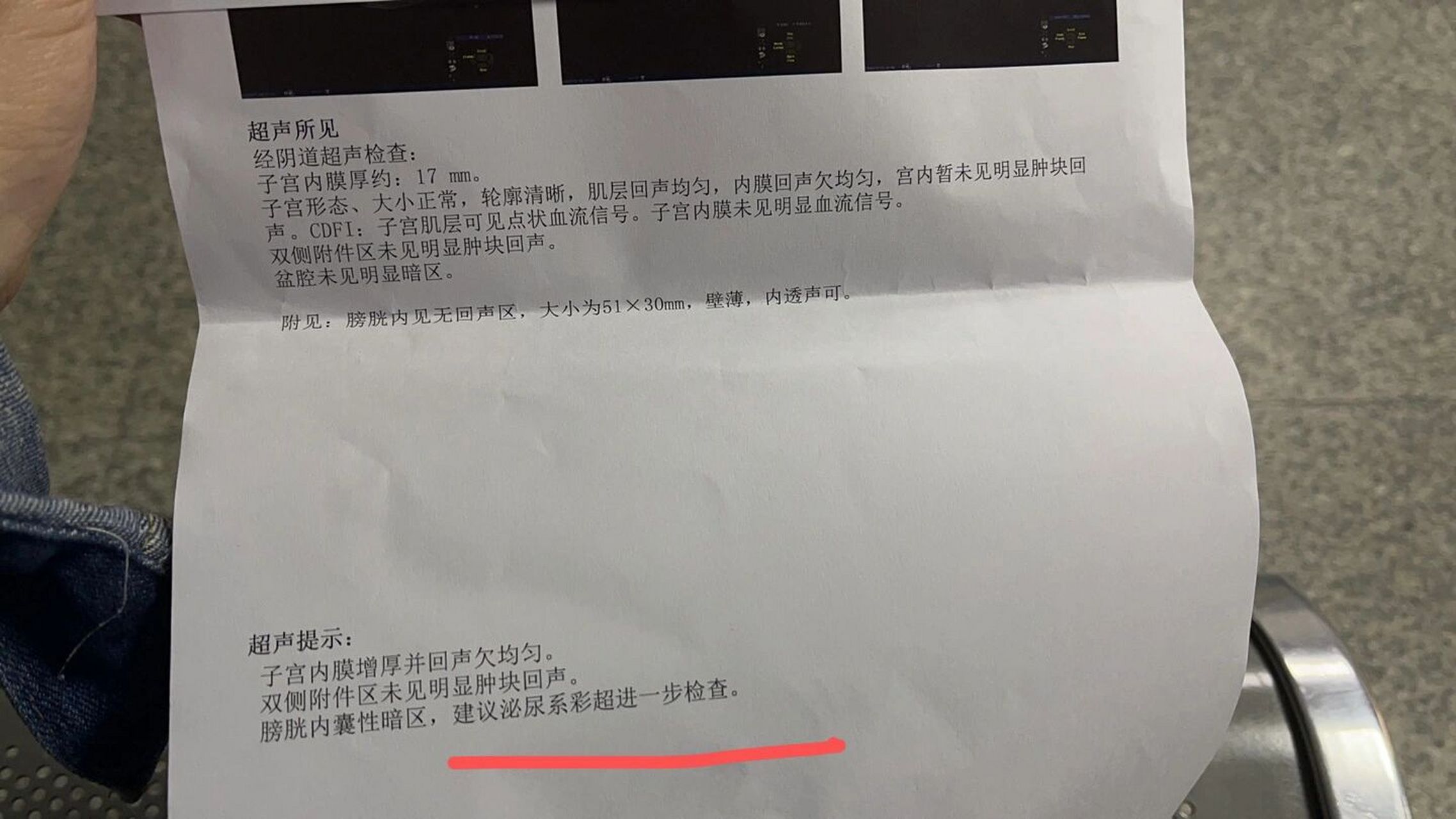囊肿一定要手术吗 2月12日前有点褐色分泌物,去做阴超查出子宫内膜太