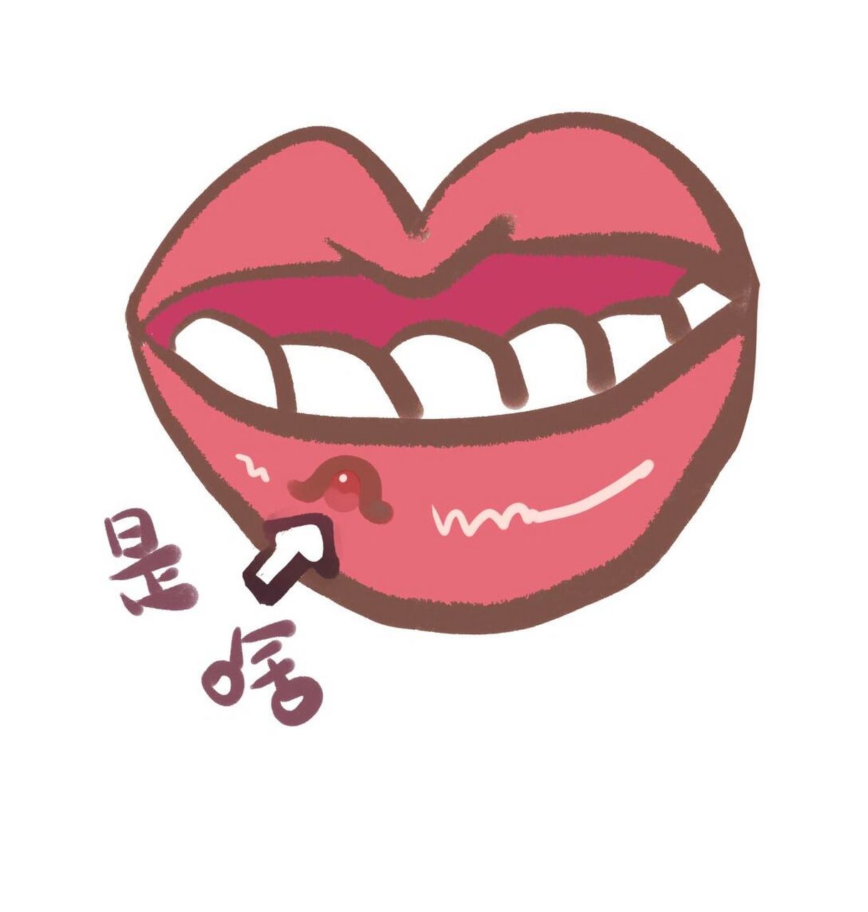 嘴唇上长了个小红点(照片在图二) 今天刚长,像口腔溃疡一样肿了,一点