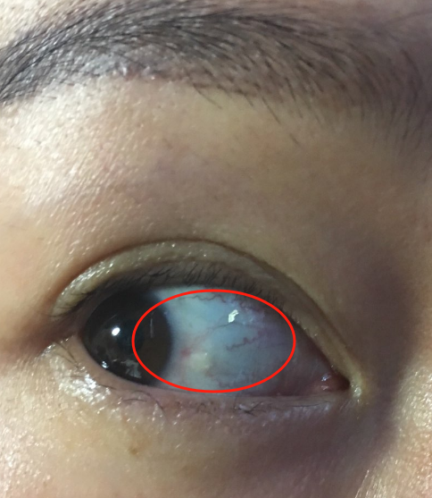 黑眼球旁边出现透明小泡,可能是角膜皮样瘤,泡性结膜炎或结膜增生