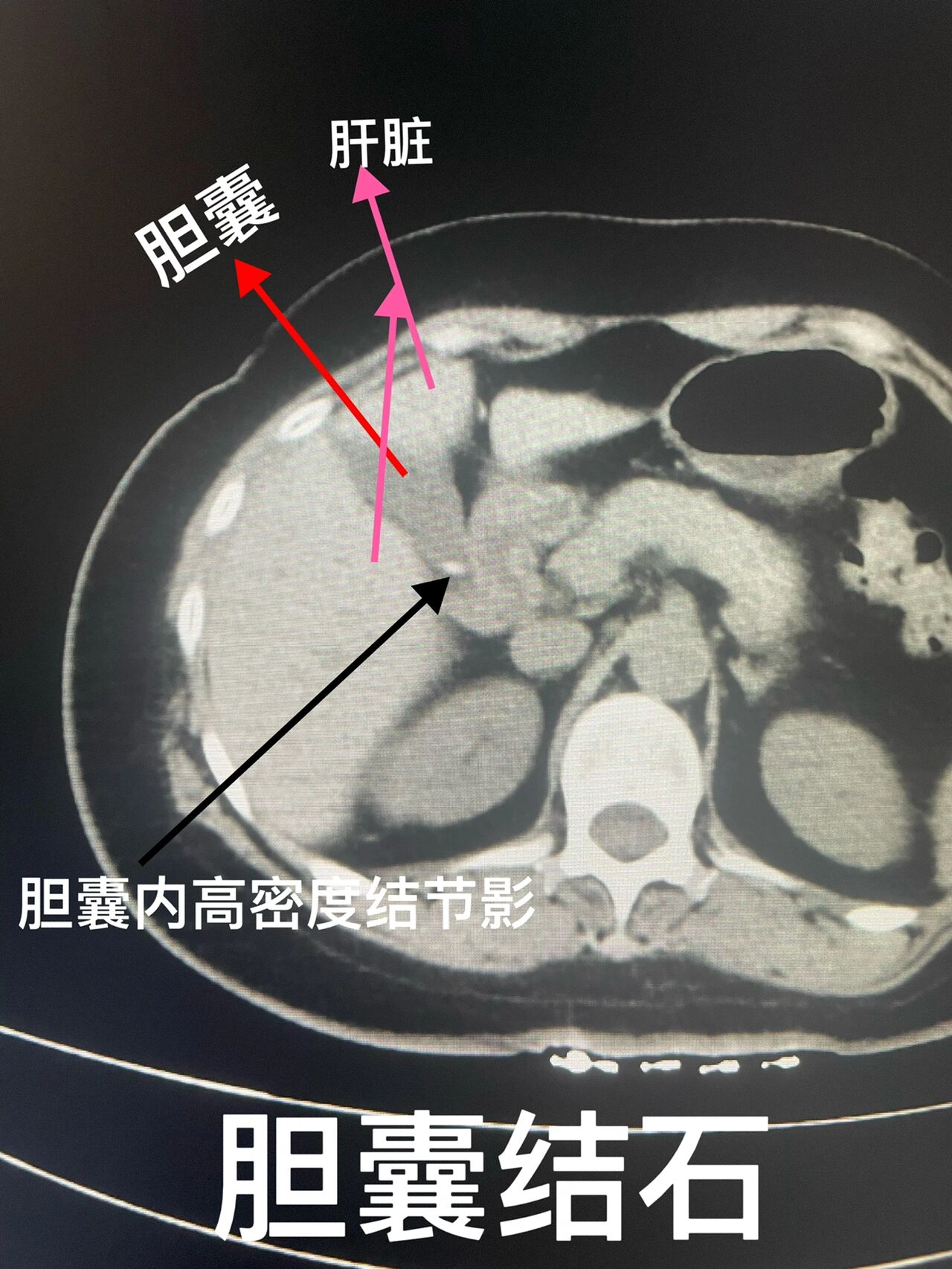 胆总管ct正常图解图片