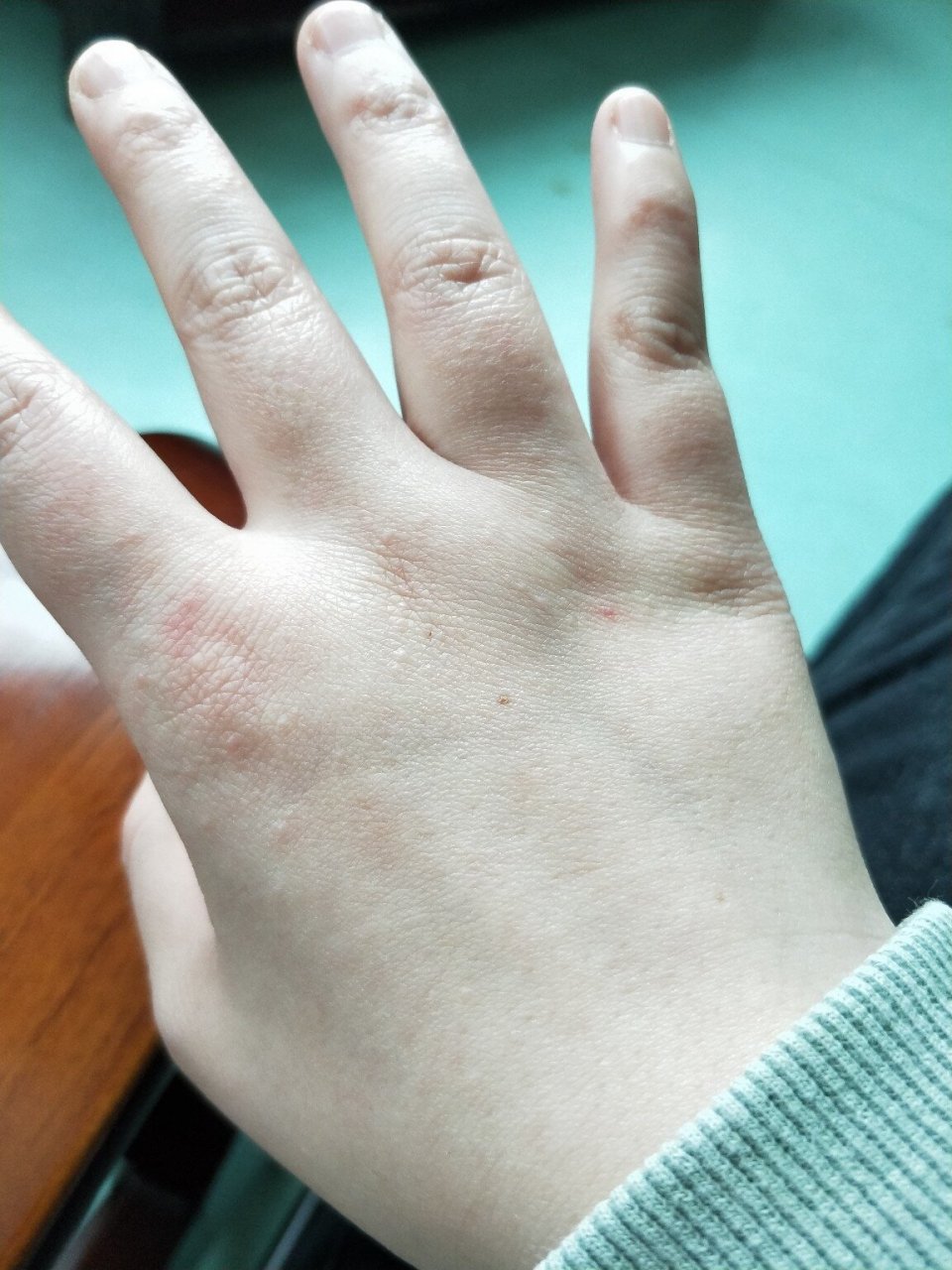 有没有和我一样手背起疹子的 无缘无故总是起疹子,也不知道啥原因,真