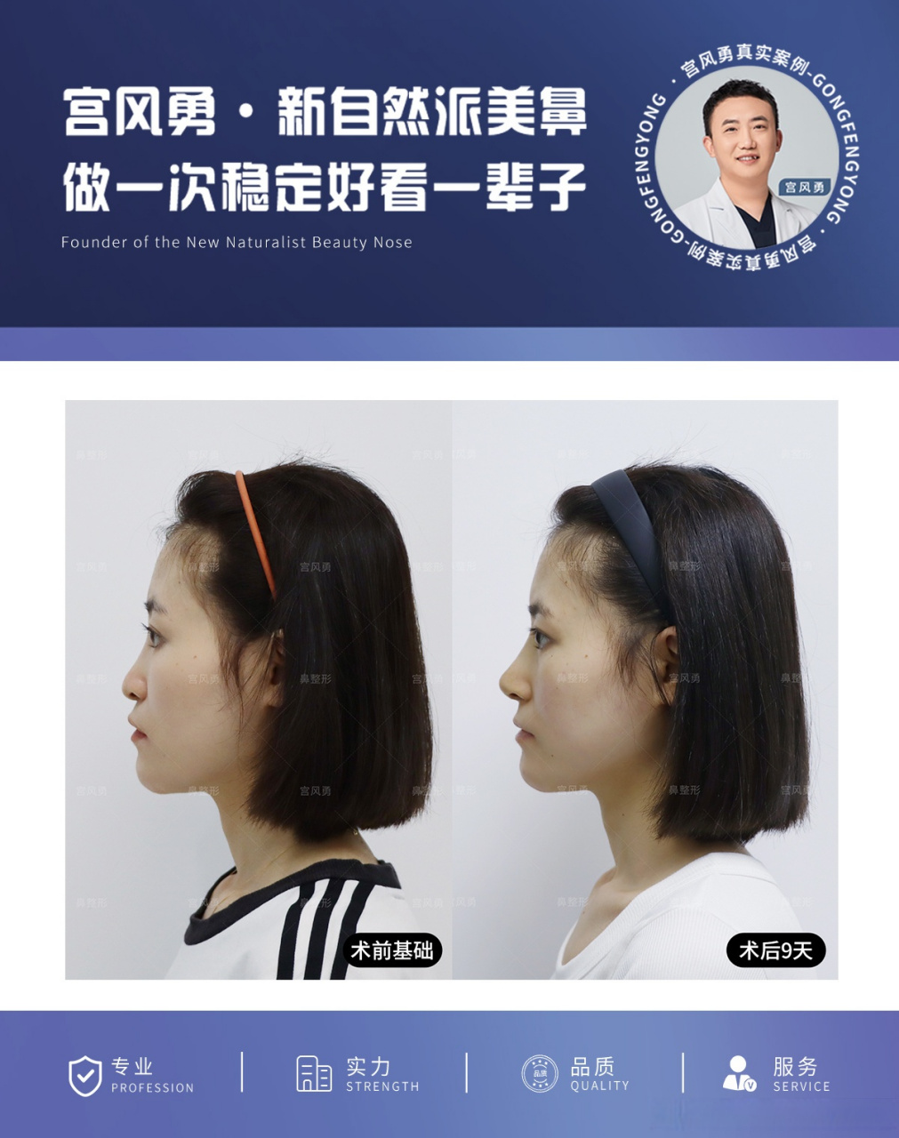 【如何摆脱显老的#箭头鼻# 】姑娘是典型的#箭头鼻# 表现形式为鼻尖