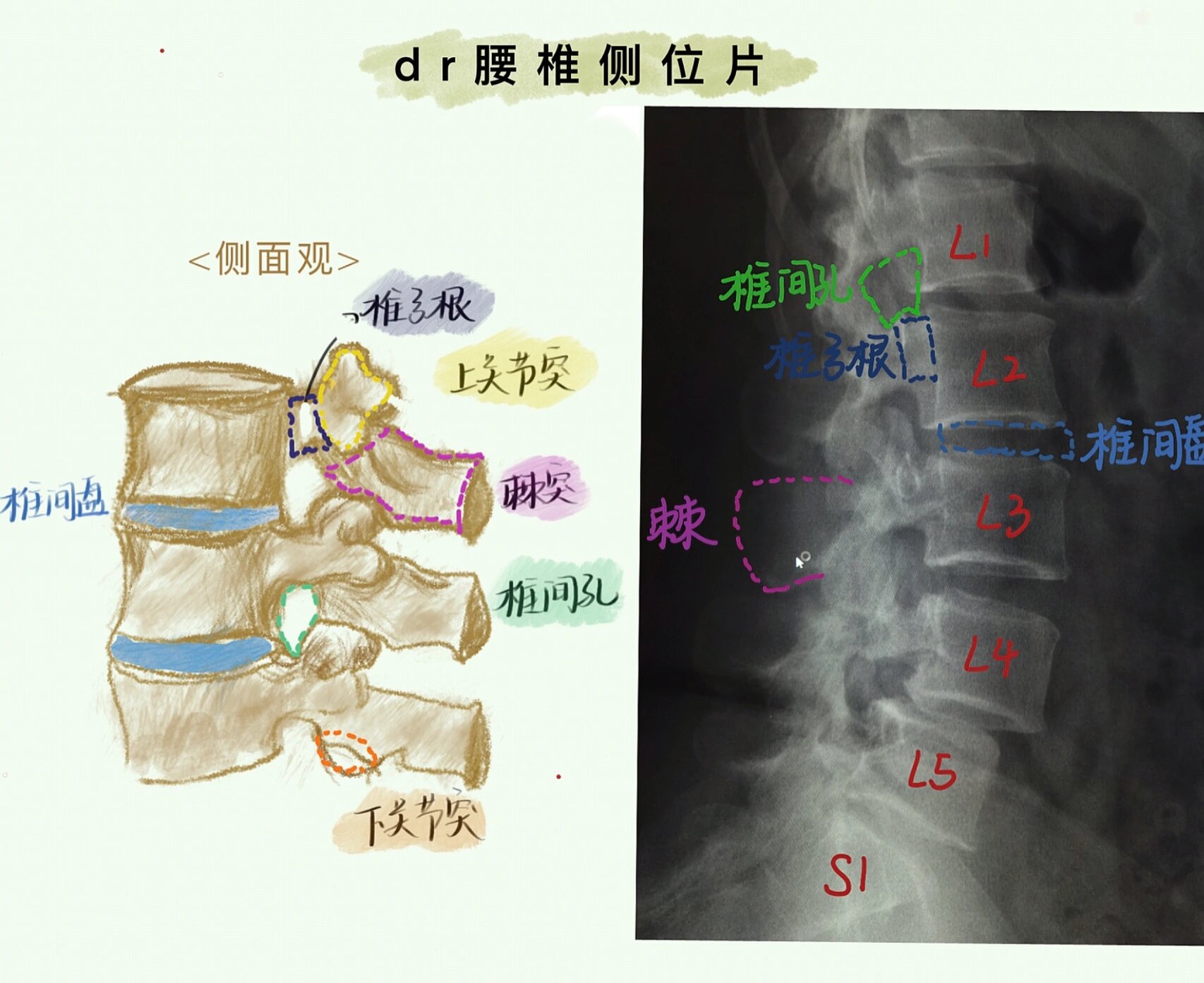 腰椎dr侧位片|腰椎解剖|腰椎间盘病变