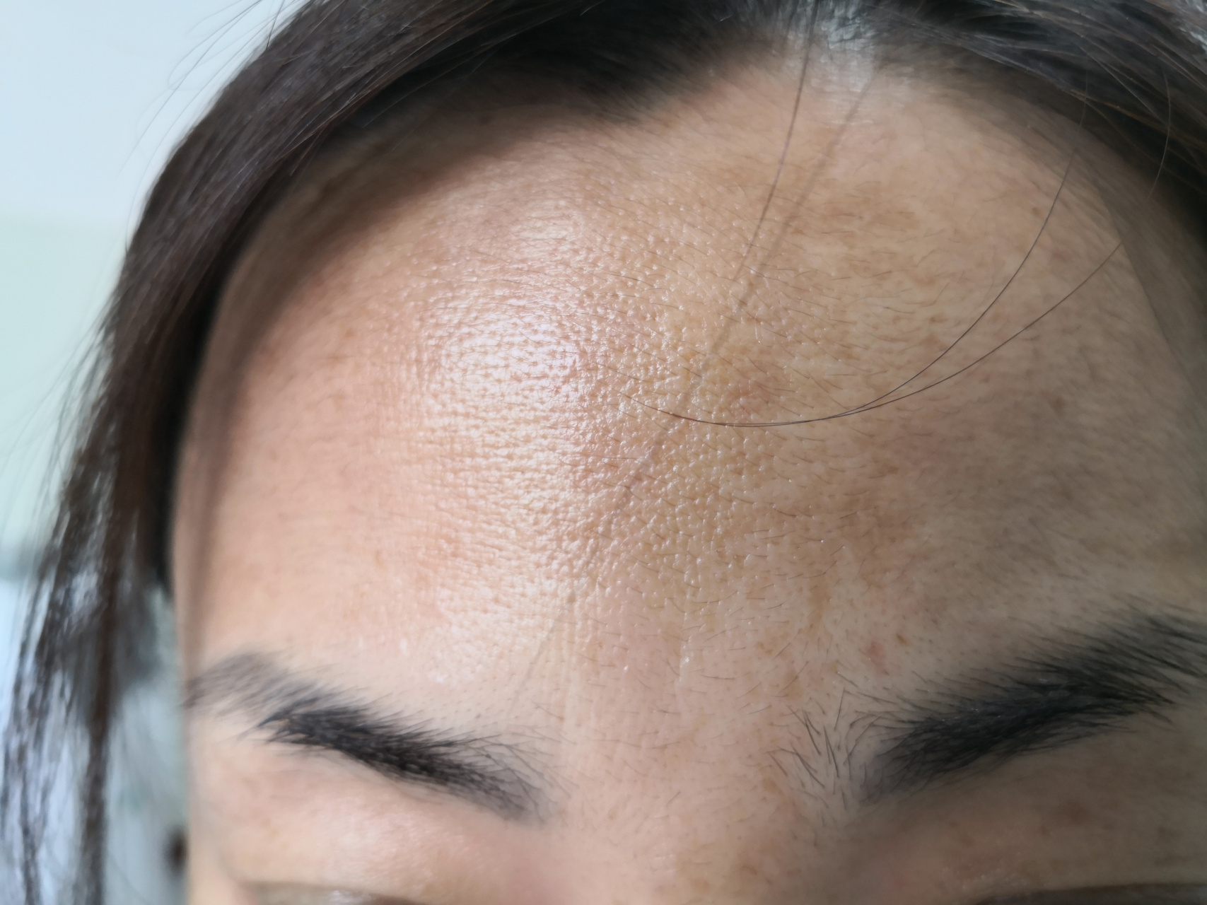 额头面颊弥漫性黄褐色斑片.