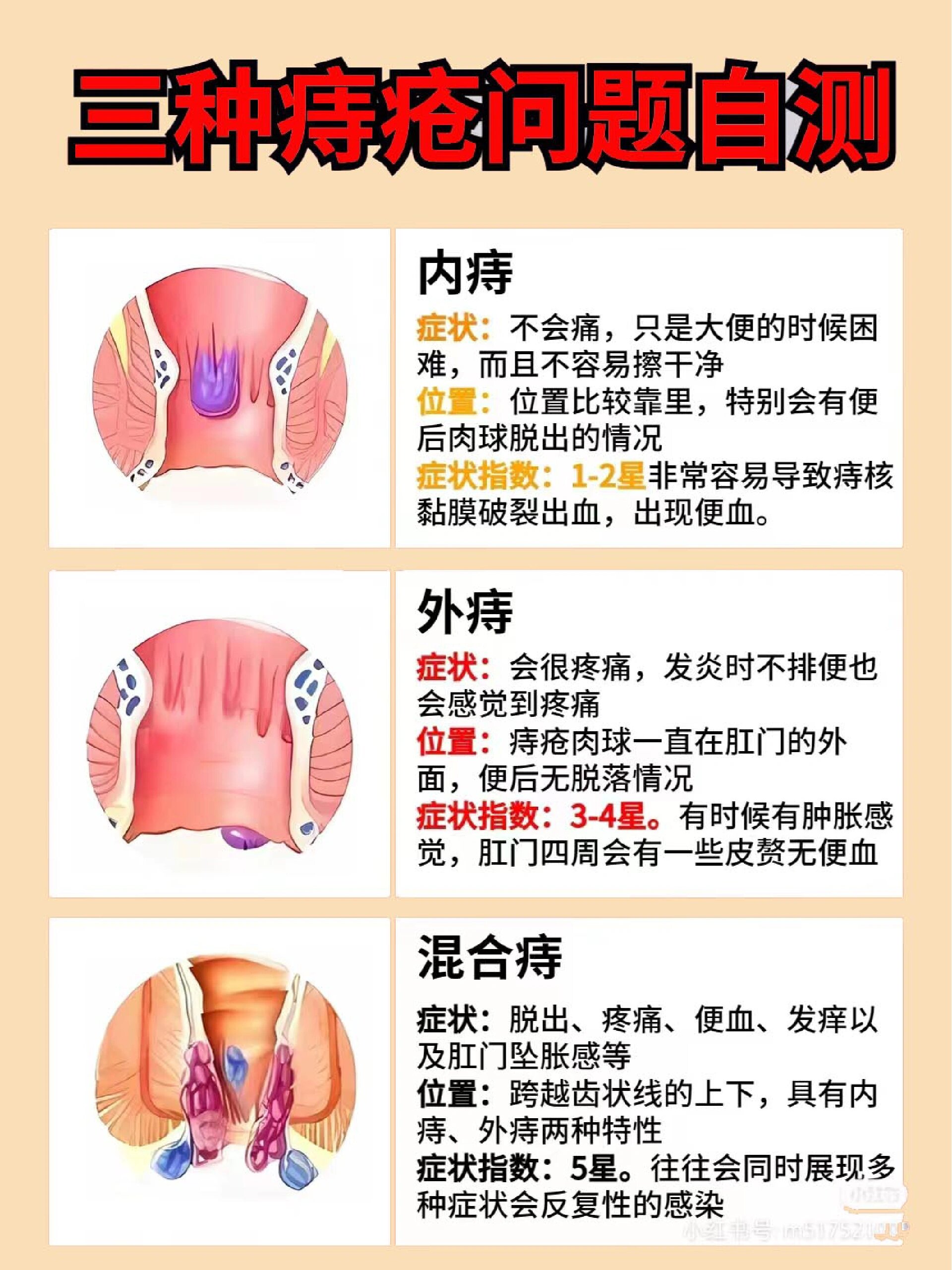 女性痔疮肉球图片图库图片