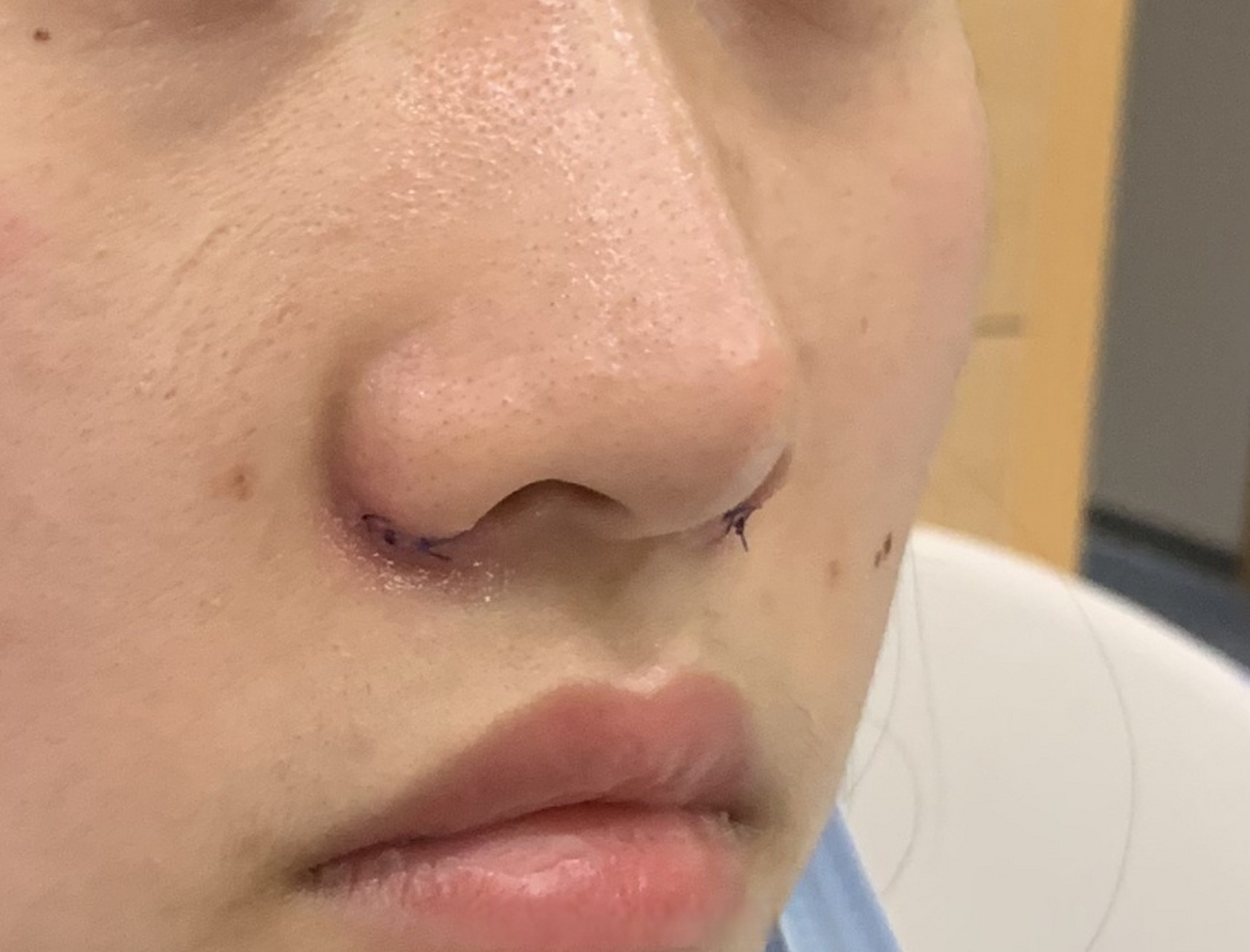 鼻整形找党宁# 【下图鼻翼缩小术后第一天状态 红肿程度很低】  到沣