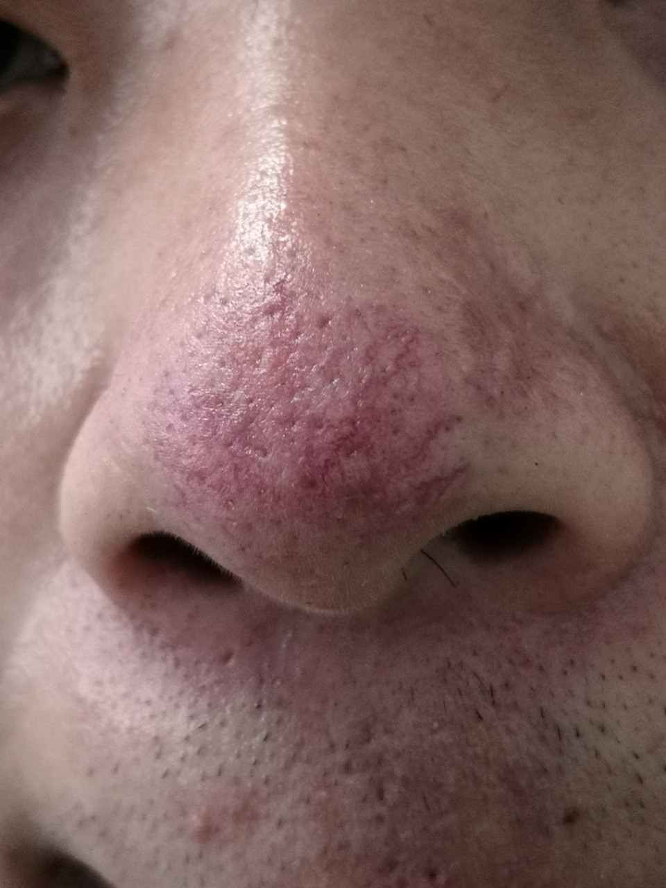 酒糟鼻症状.可以使用激光治疗去除红血丝和肥厚性斑块.