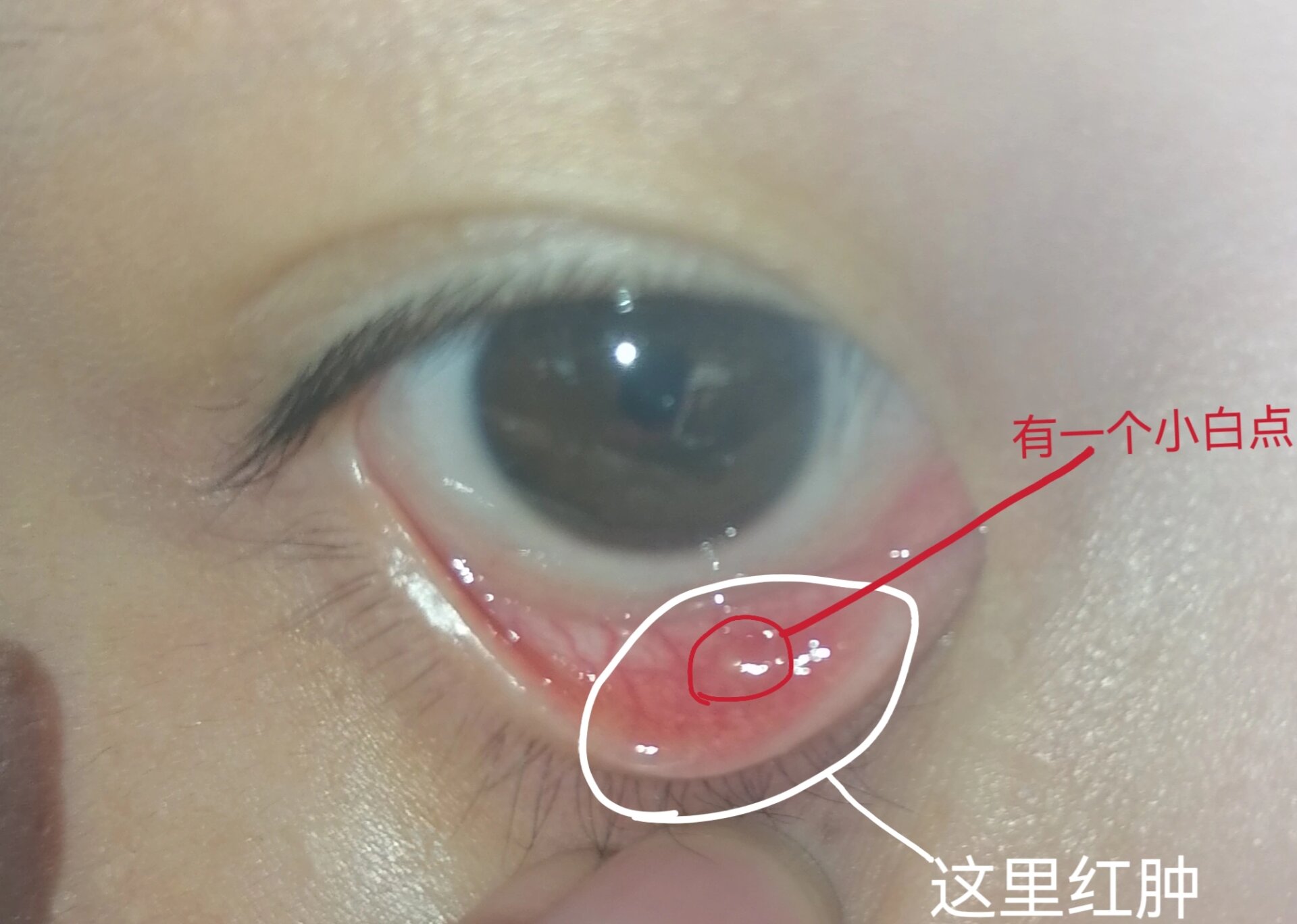 戴美瞳戴的眼睛好疼 怎么办啊家人们