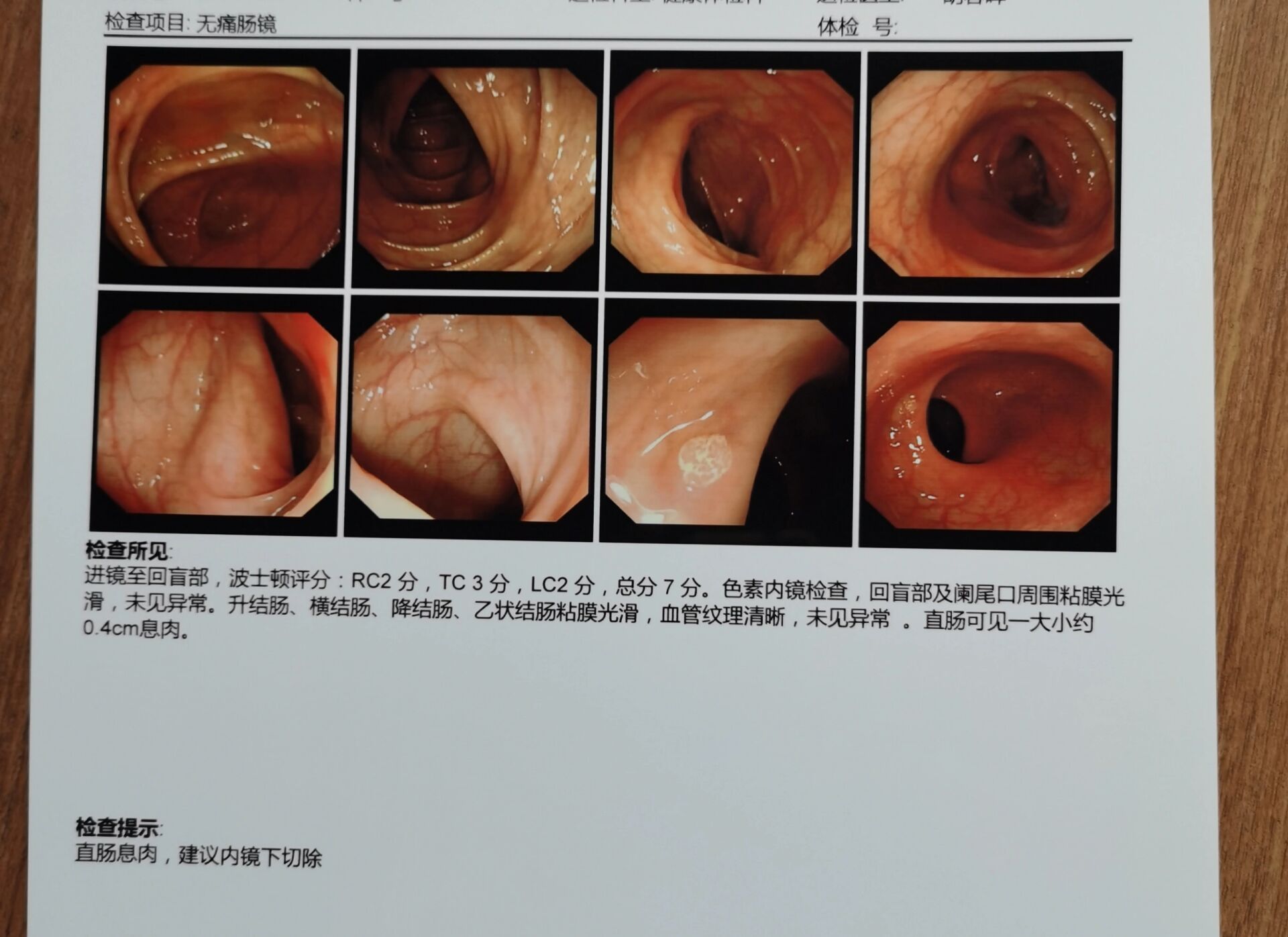 胃肠镜检查后,胃肠都有息肉,现在打算做了.