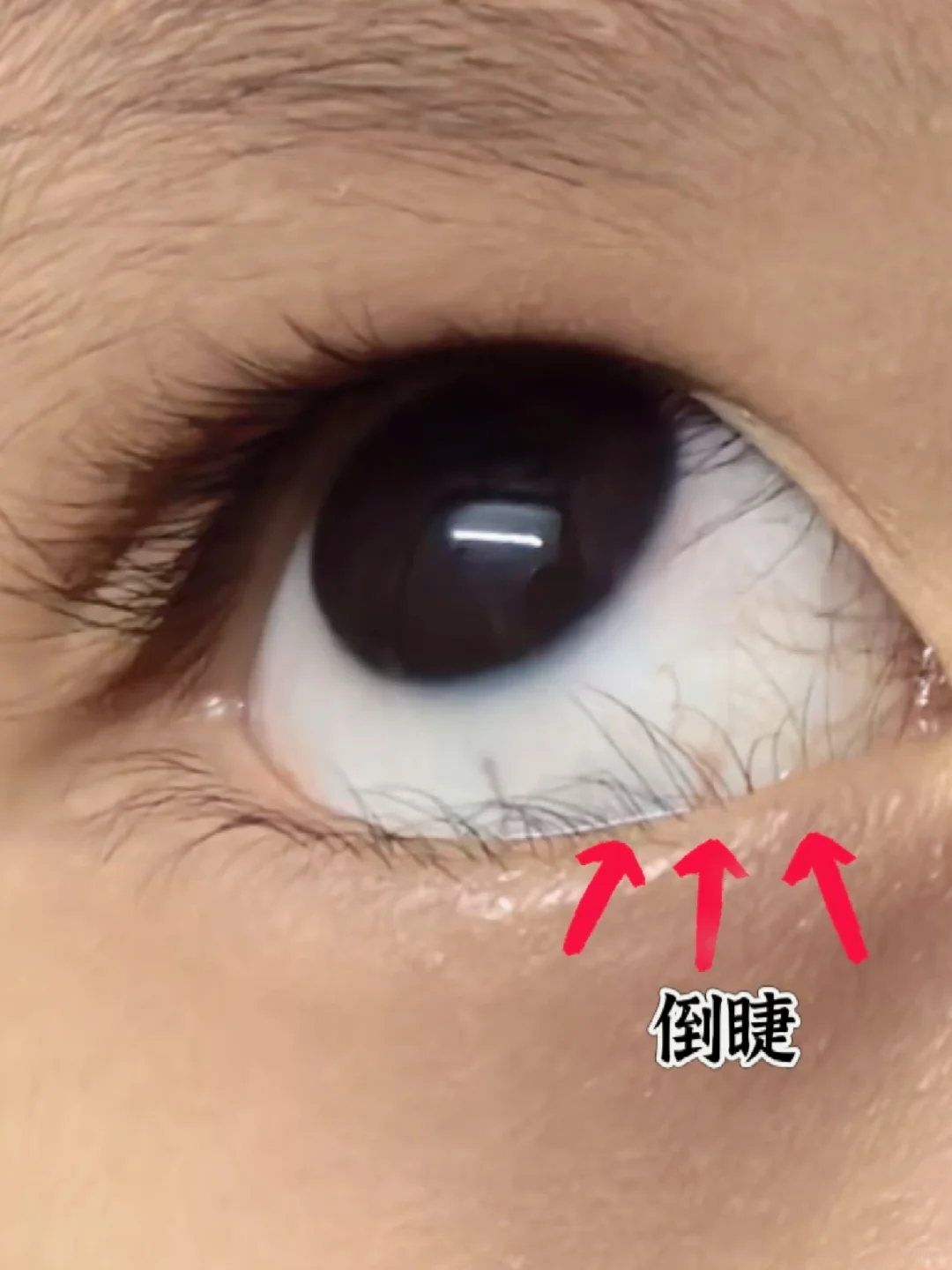 睫毛戳眼睛在医学上叫倒睫,就是睫毛往眼球方向长,碰到眼睛了