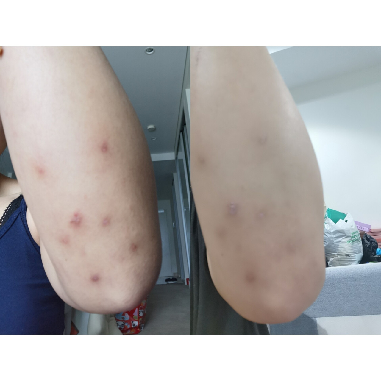 床虱咬伤#7天去疤