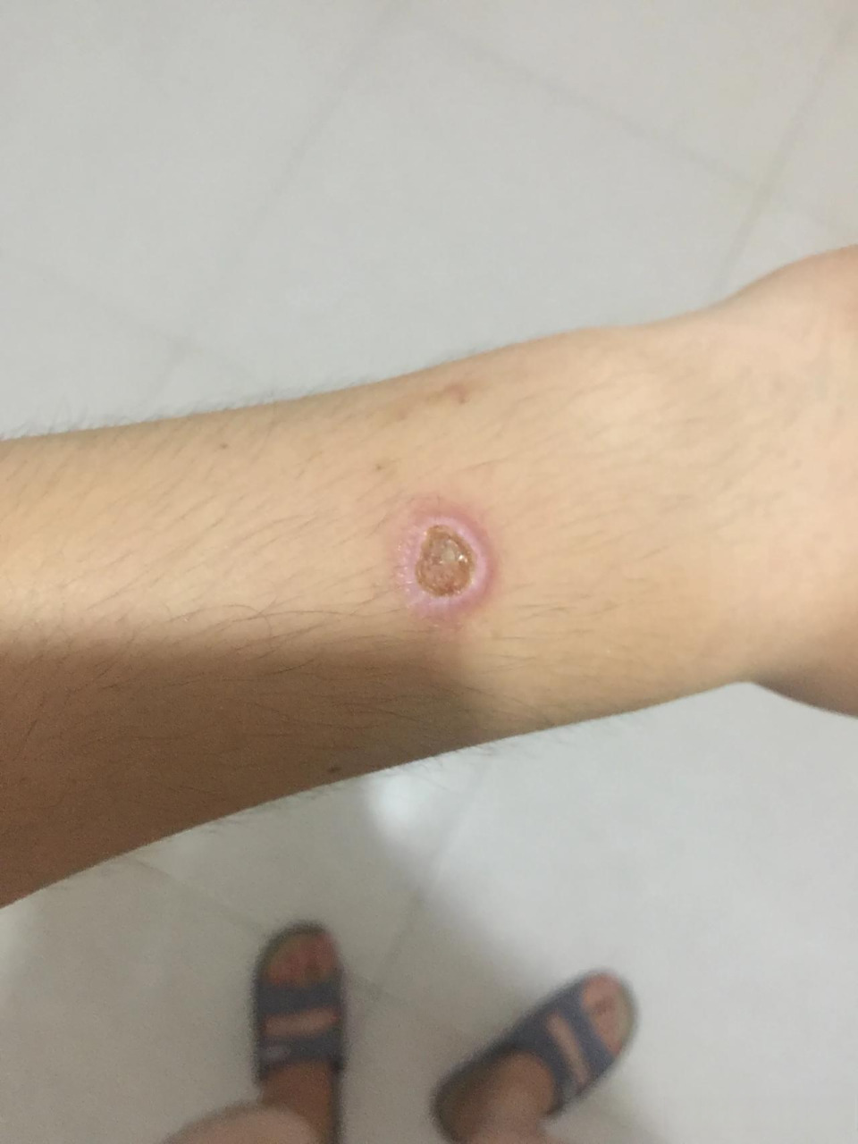 你烫过烟疤吗?后悔不?