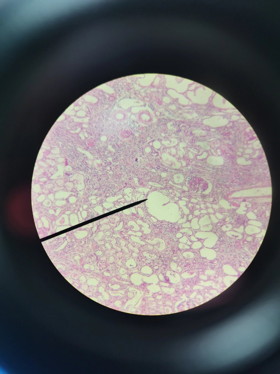 病理切片-慢性肾盂肾炎 慢性肾盂肾炎 诊断描述:低倍镜下,可见大量肾