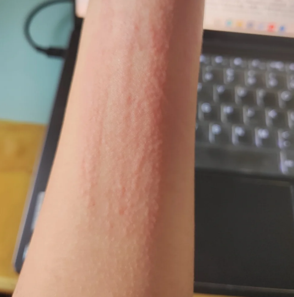 皮肤汗液过敏症状?