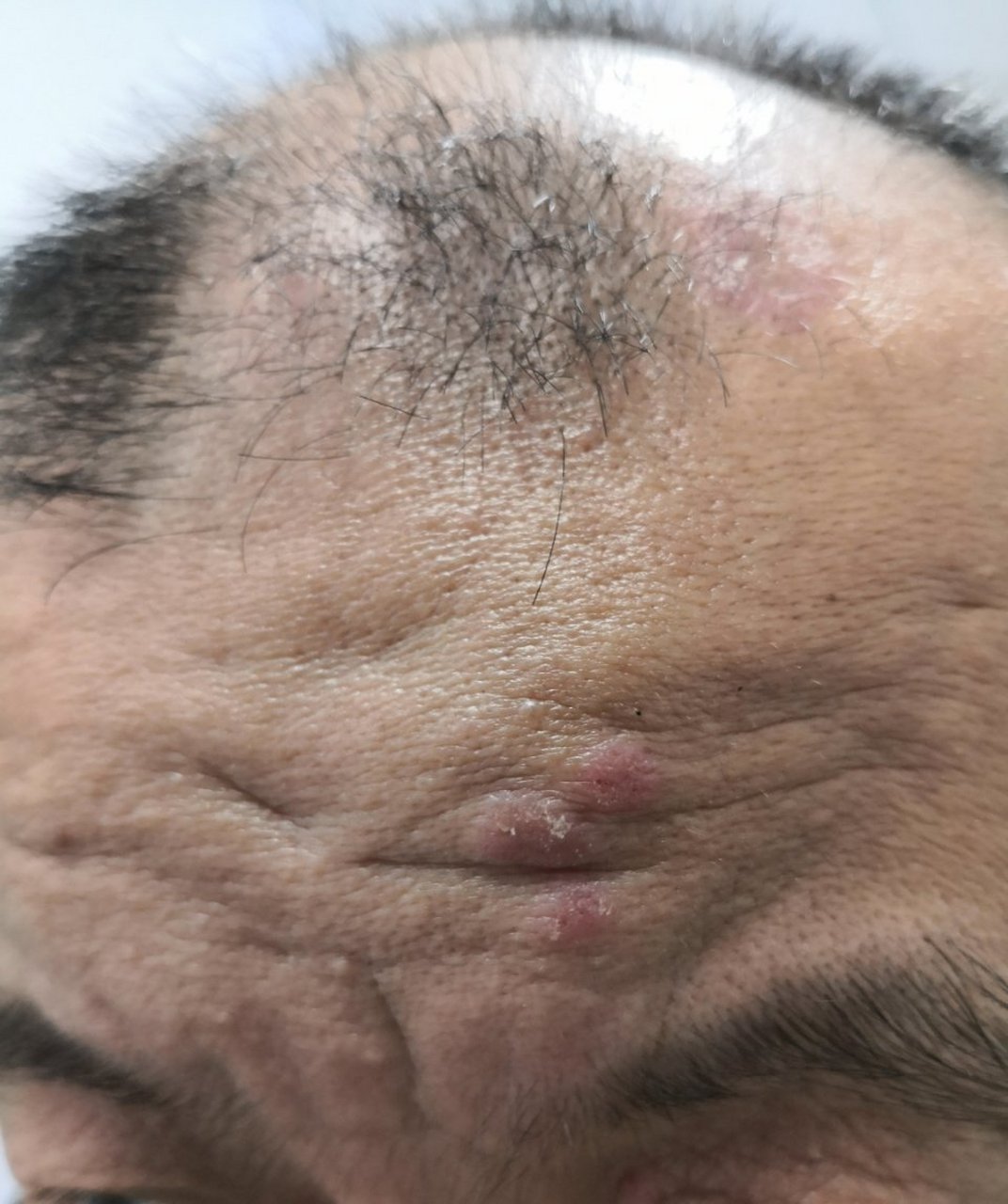 红皮病型银屑病患者使用生物制剂治疗后,银屑病患者头皮面部颈部臀部