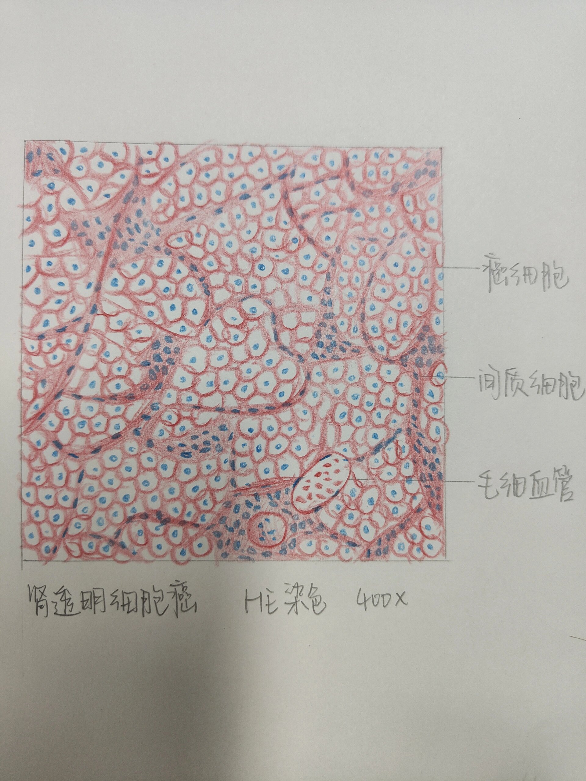 霍奇金细胞红蓝铅笔图图片