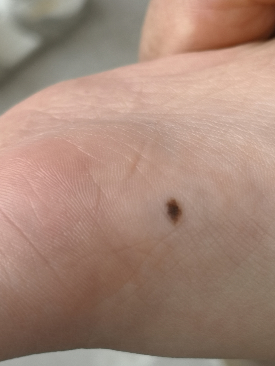 解决皮肤问题专注皮肤美容##色素痣