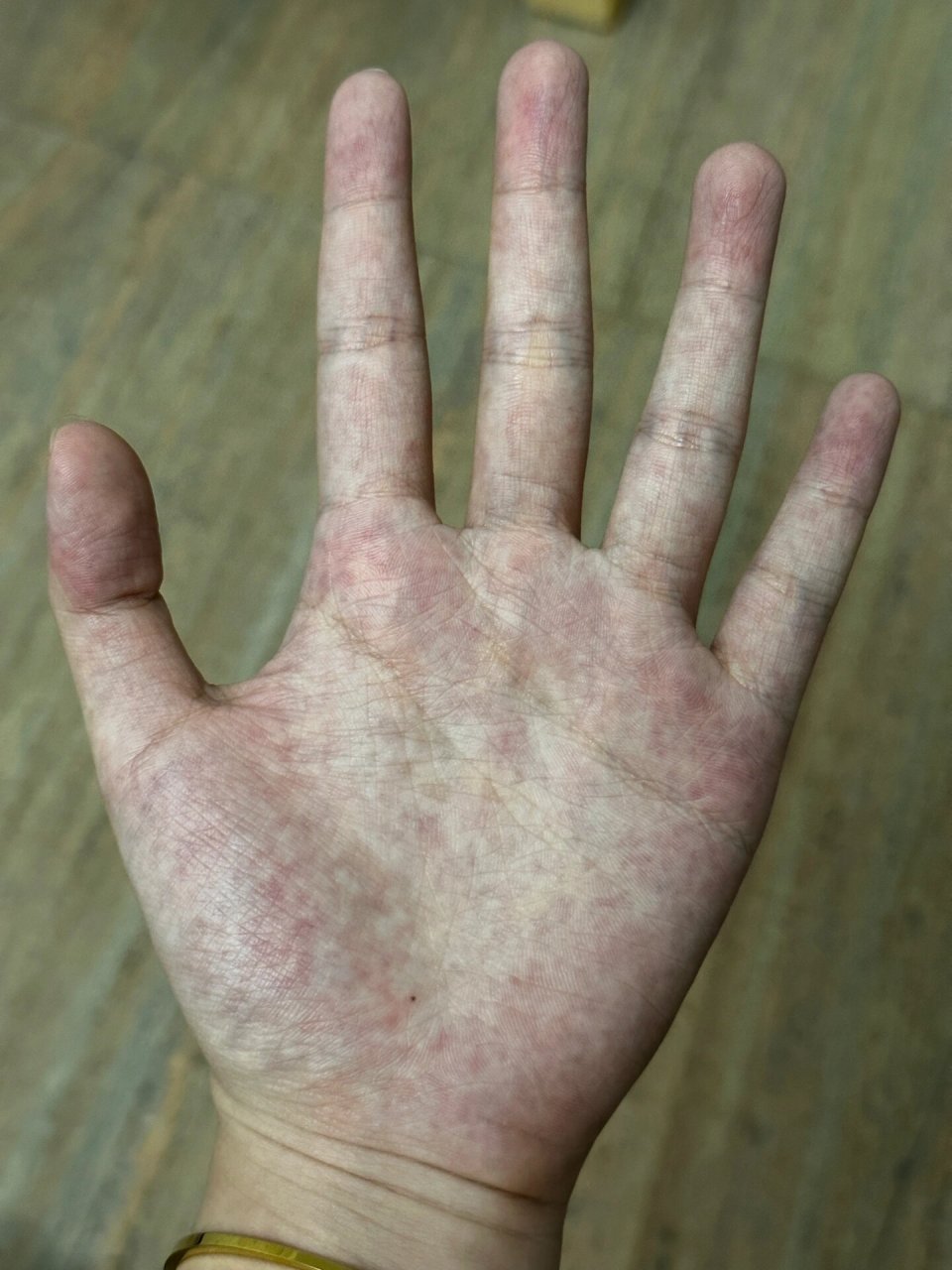 左手掌突然长了颗痣 这是咋啦 七月份突然发现自己手掌内莫名张了颗痣