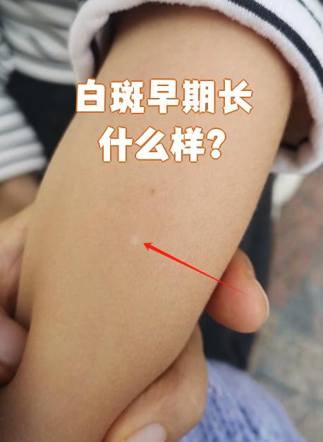 白斑病有很多种类型,表现也不太一样.如果发现白斑颜色