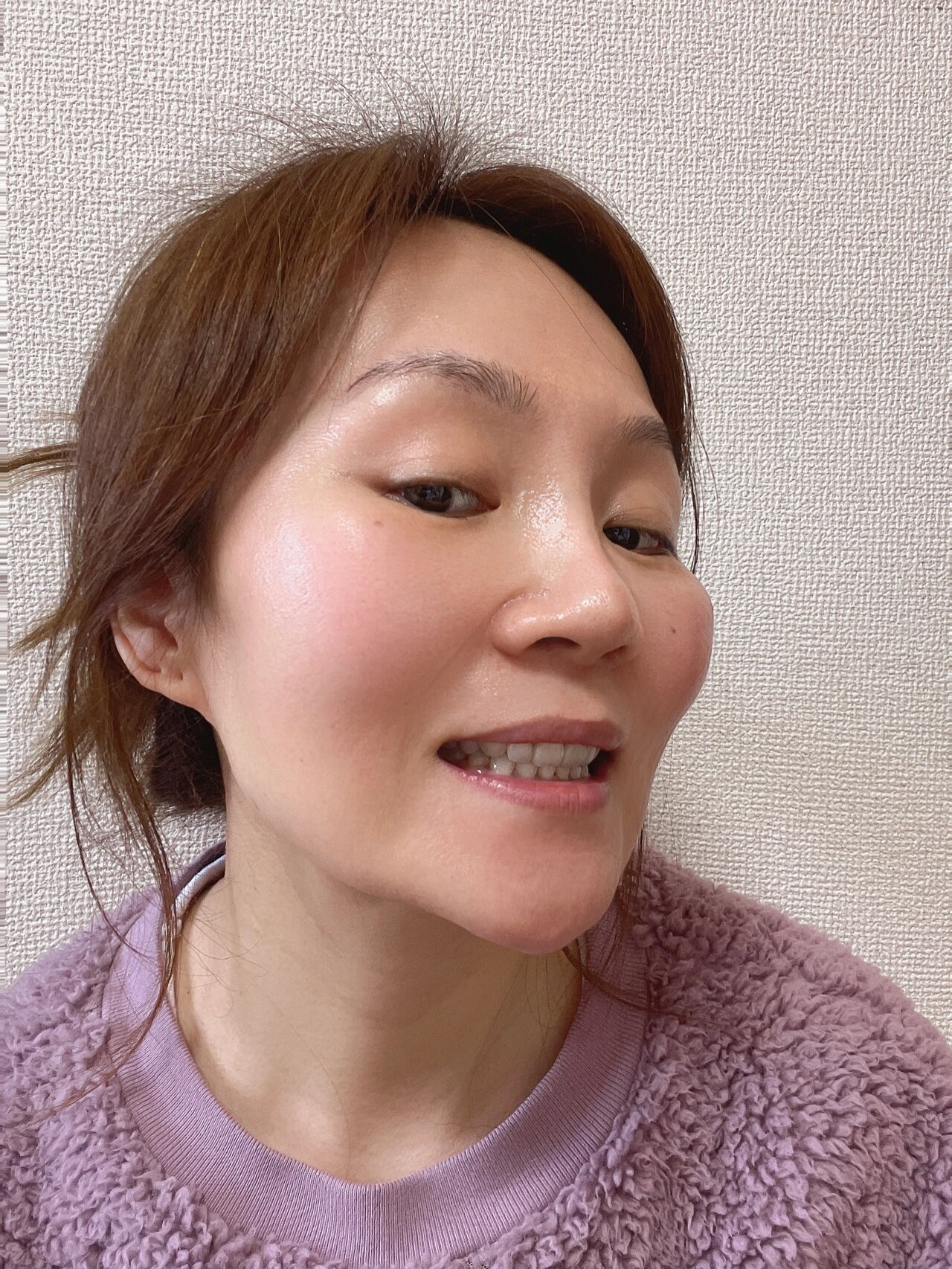 内收太过了,整个牙齿都是往里内扣的,太影响美观了,但是我