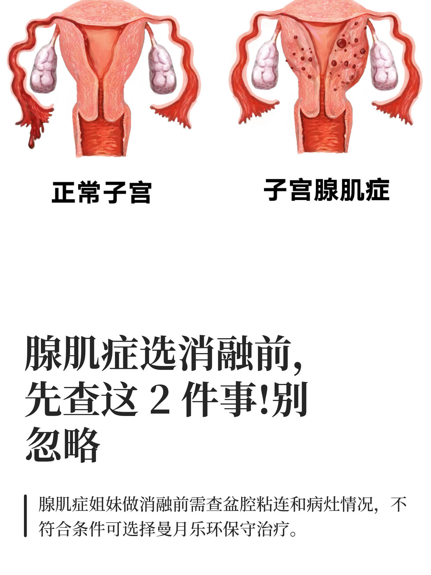 通过 mri 或腹腔镜检查看病灶是否和膀胱肠道输卵管粘连