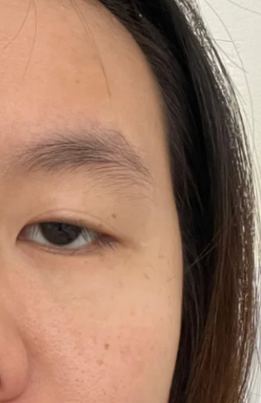 眼睑下垂需要治疗吗?答案是肯定的