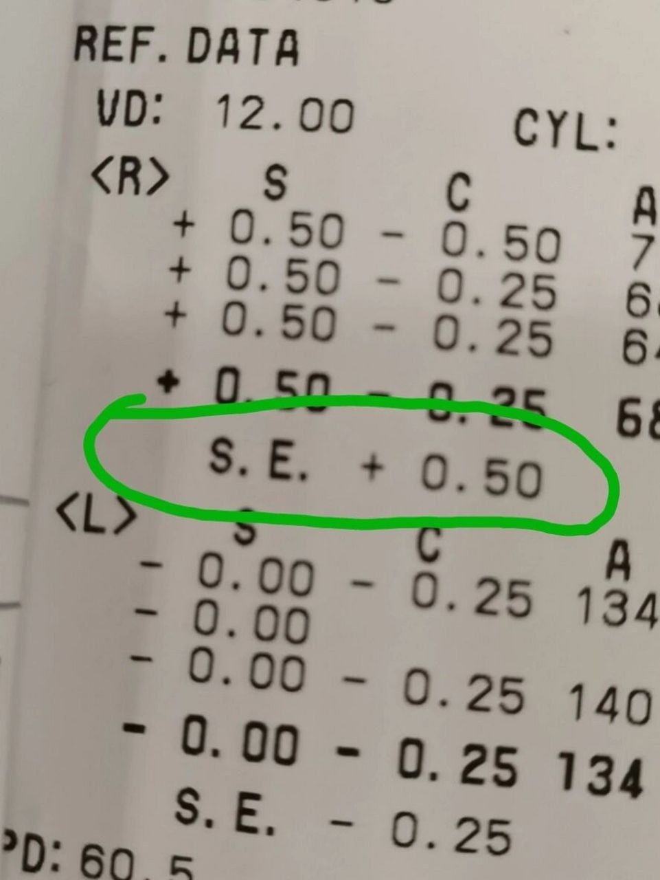 等效球镜: 等效球镜度(se)=球镜度 1/2柱镜度.