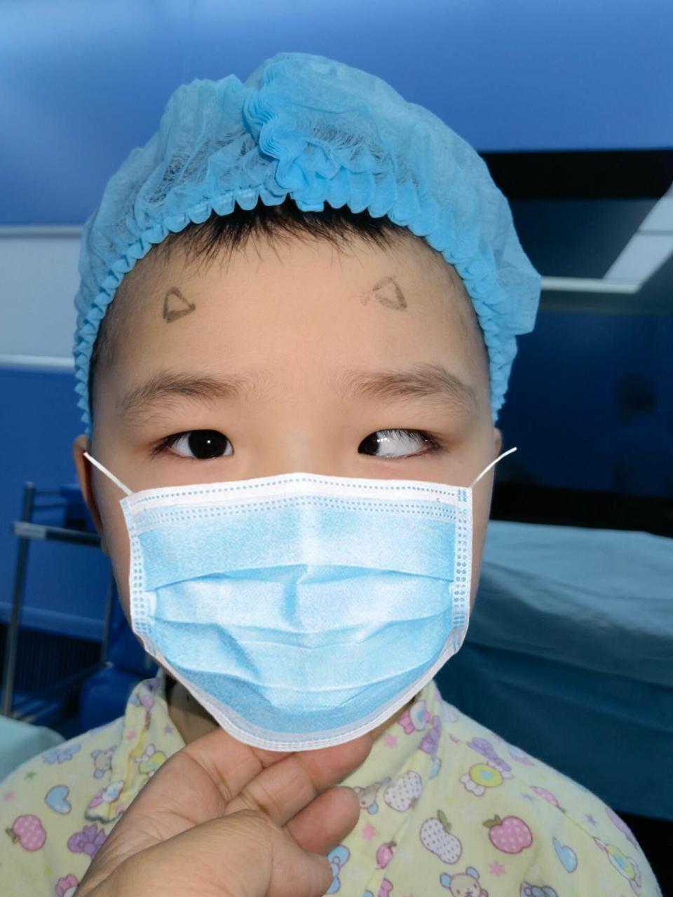 如果孩子有大度数的内斜视,就要考虑手术治疗.