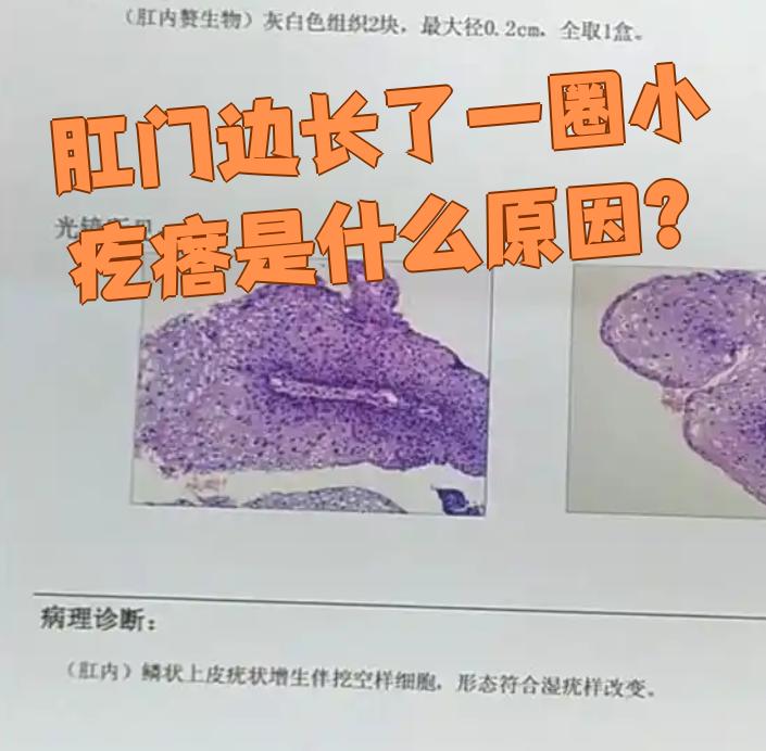 肛门周围长小疙瘩常见原因有尖锐湿疣,肛门痔疮和肛门湿疹,需要根据