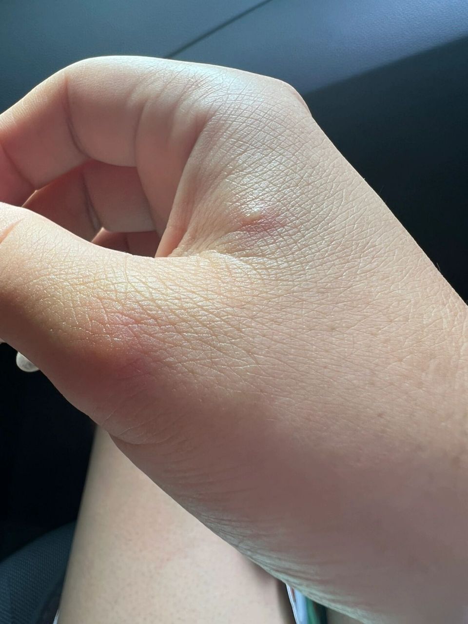 蚊子咬完起了小水泡吗?