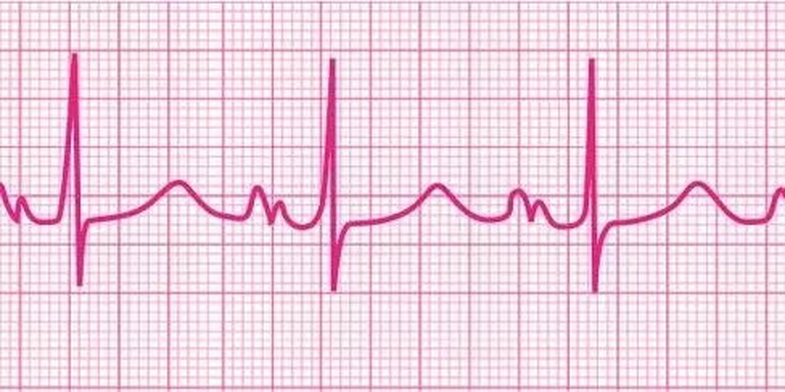 如果左心房扩大,左心房波将会比右心房波更加延迟,导致p波的宽度会
