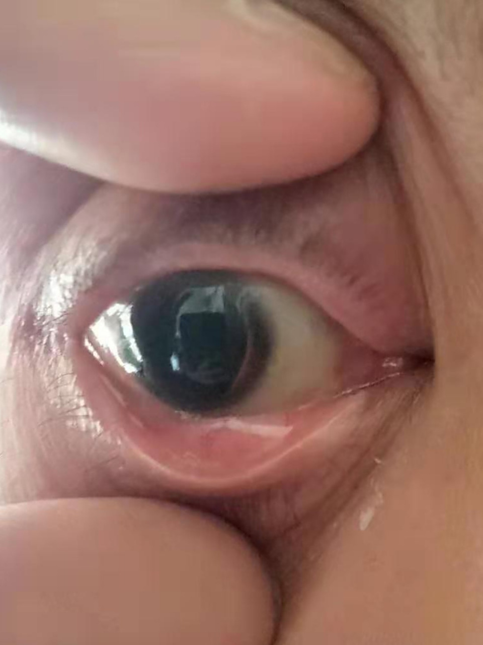 在去医院治疗时,右眼本来就瞳孔散大并且欹侧,医生还给他散瞳,这已经