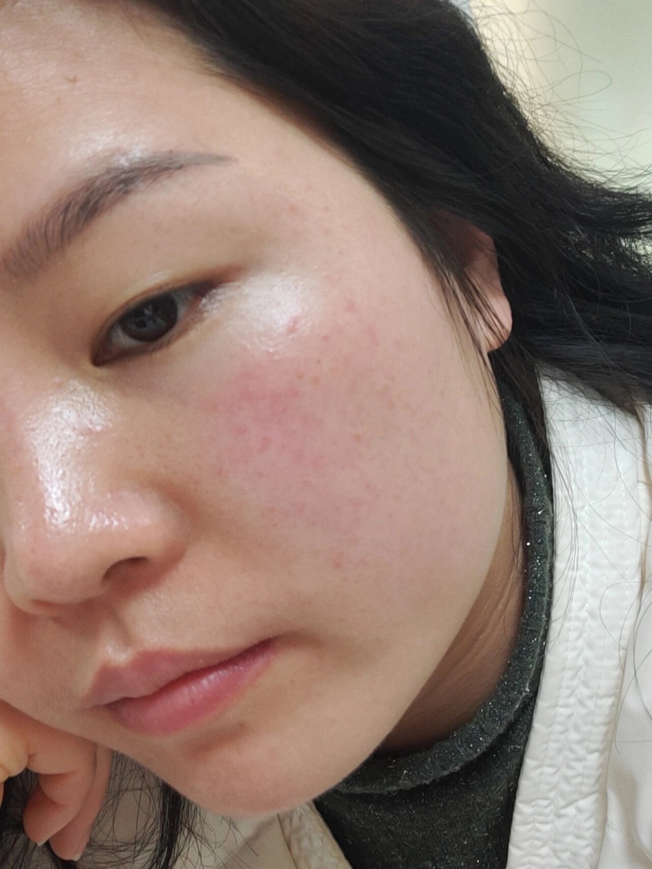 玫瑰痤疮能不能彻底治好?