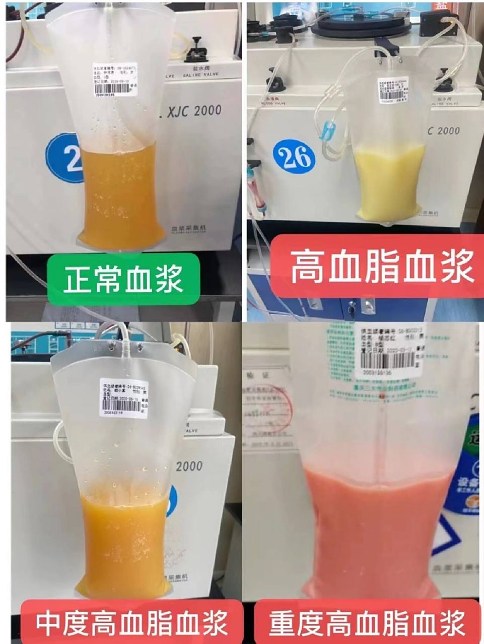 想看看你的血浆是什么颜色吗?  ​ 献血浆的好处: 1,预防三高,降低