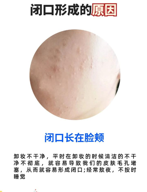 为什么会长闭口粉刺为什么在线