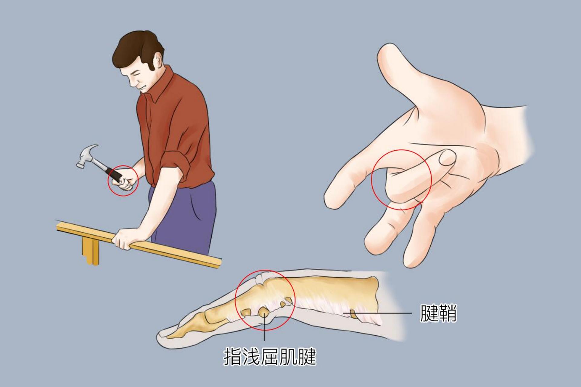 98腱鞘炎是关节附近的腱鞘内慢性损伤性炎症改变,可产生局部疼痛与