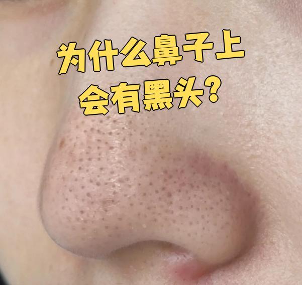 为什么有黑头怎么产生的百科在线