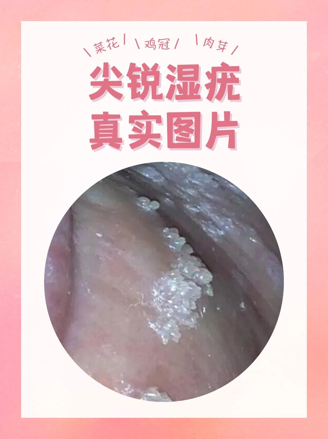 典型的皮损呈菜花样,鸡冠样,乳突样,条索样等外观