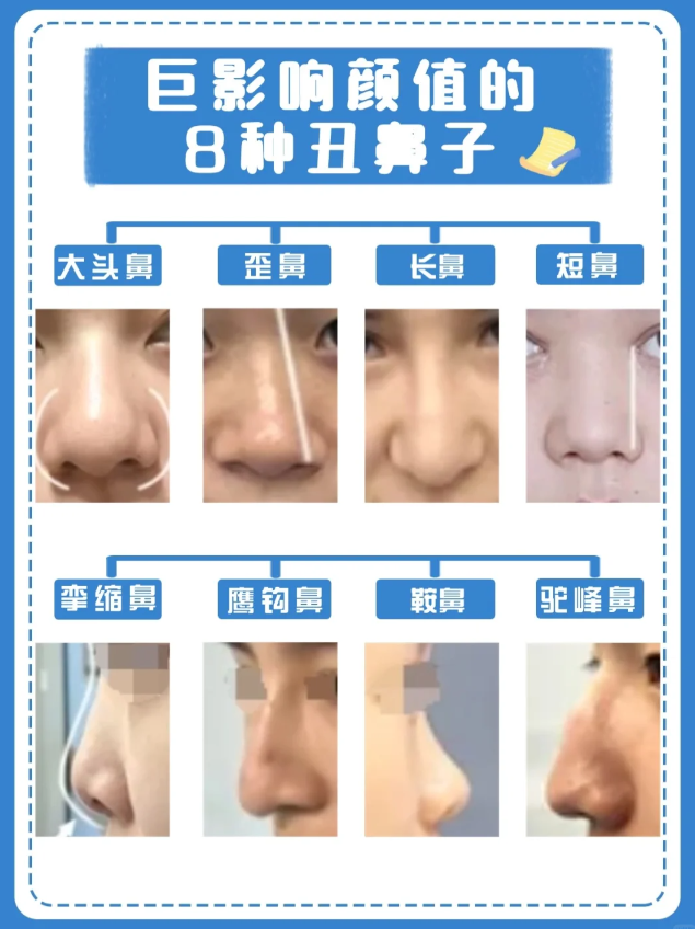 短鼻延长 延长鼻中隔软骨长度,分离鼻中隔软骨,鼻翼软骨,再取肋软骨