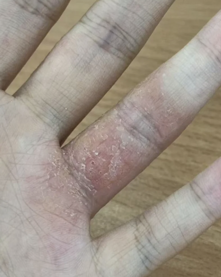 手指缝脱皮,溃烂,开裂最常见的原因是手癣,湿疹或细菌感染