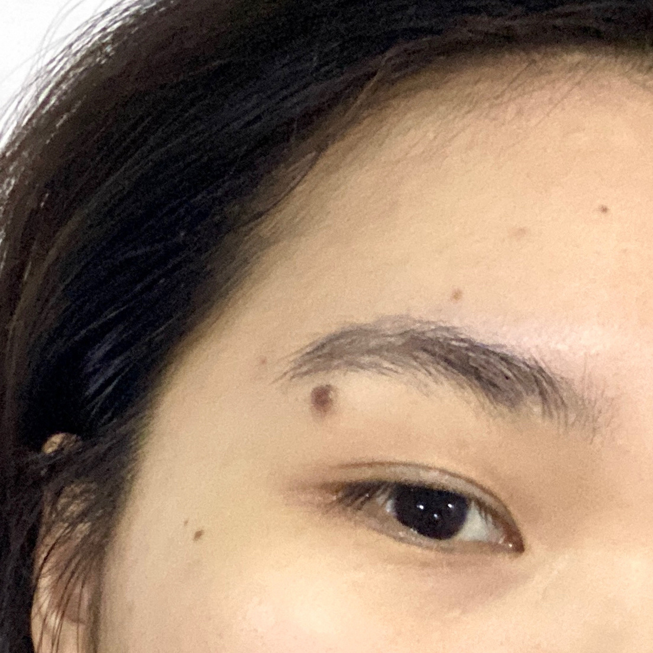 眼皮痣终于切掉了 我是去东莞人民医院红楼院区,挂的是医学美容科